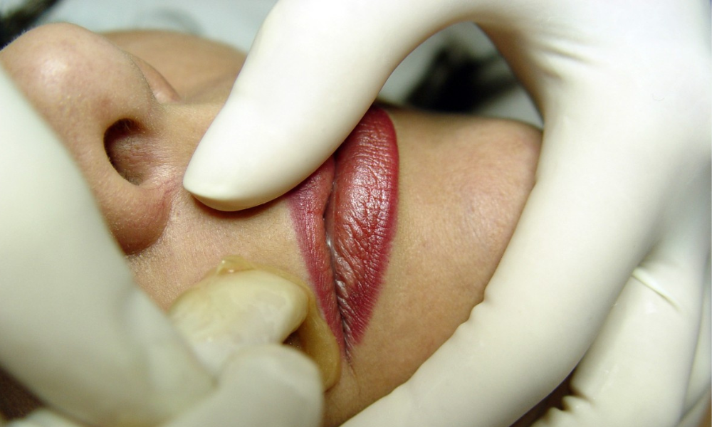 Injerto graso en labios