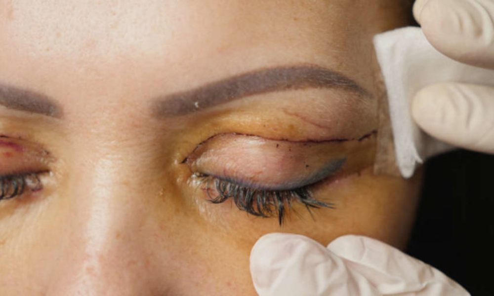 Blefaroplastias Superior e Inferior
