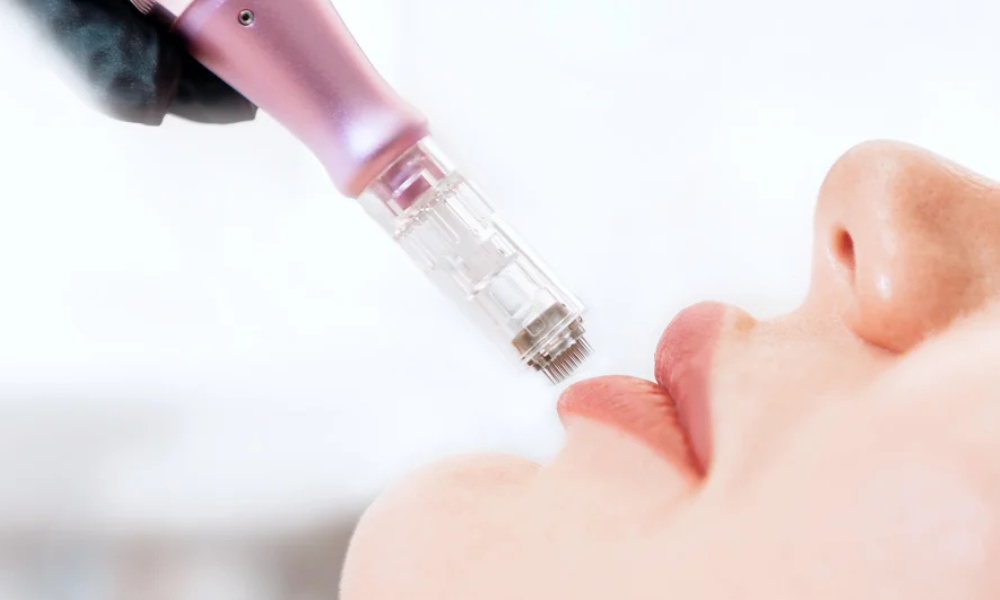 Hidratación de labios con dermapen